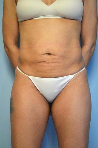Umbilical Float Tummy Tuck Before & After Gallery - Patient 230754 - Image 2