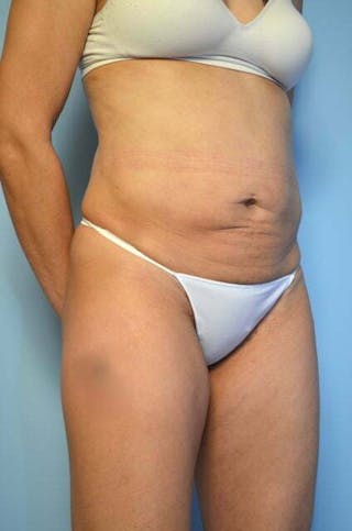 Umbilical Float Tummy Tuck Before & After Gallery - Patient 230754 - Image 4