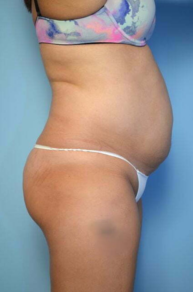 Liposuction Before & After Gallery - Patient 168913 - Image 5