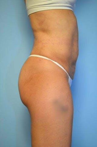 Umbilical Float Tummy Tuck Before & After Gallery - Patient 230754 - Image 6
