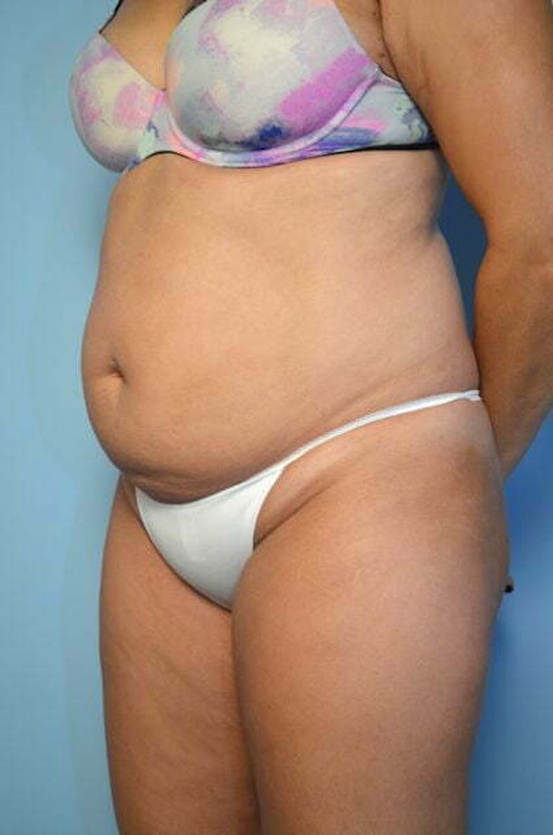 Liposuction Before & After Gallery - Patient 168913 - Image 7
