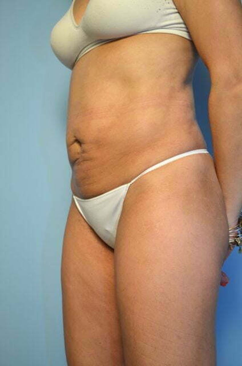 Liposuction Before & After Gallery - Patient 168913 - Image 8