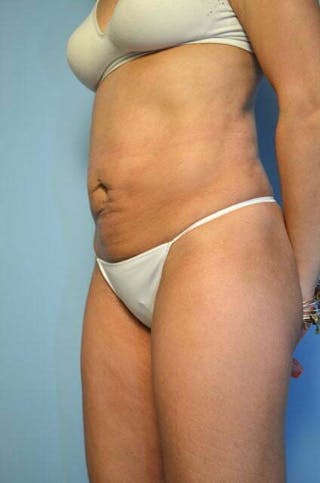 Umbilical Float Tummy Tuck Before & After Gallery - Patient 230754 - Image 8