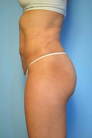 Umbilical Float Tummy Tuck Before & After Gallery - Patient 230754 - Image 10