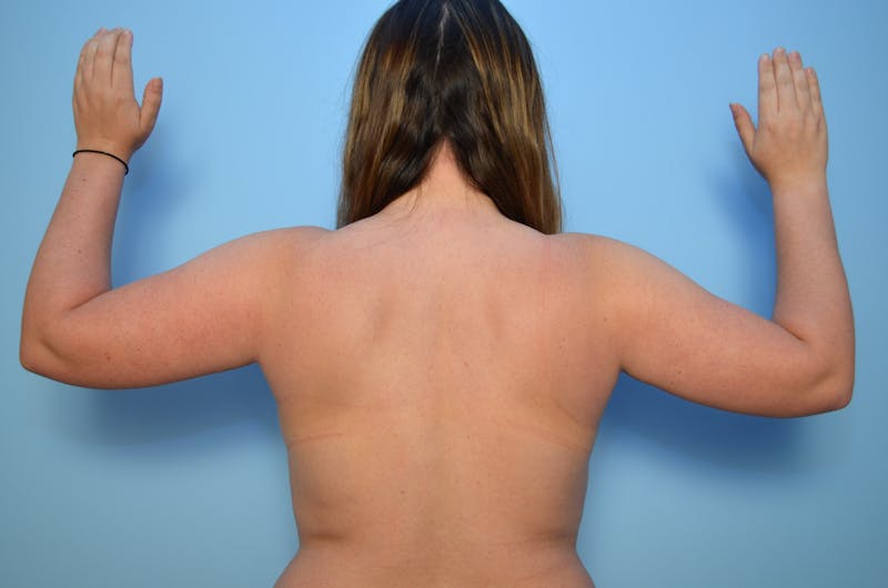 Liposuction Before & After Gallery - Patient 223613 - Image 1