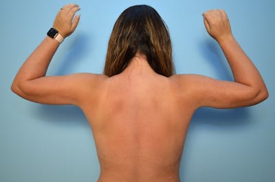 Liposuction Before & After Gallery - Patient 223613 - Image 2