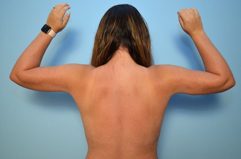 Liposuction Before & After Gallery - Patient 223613 - Image 2