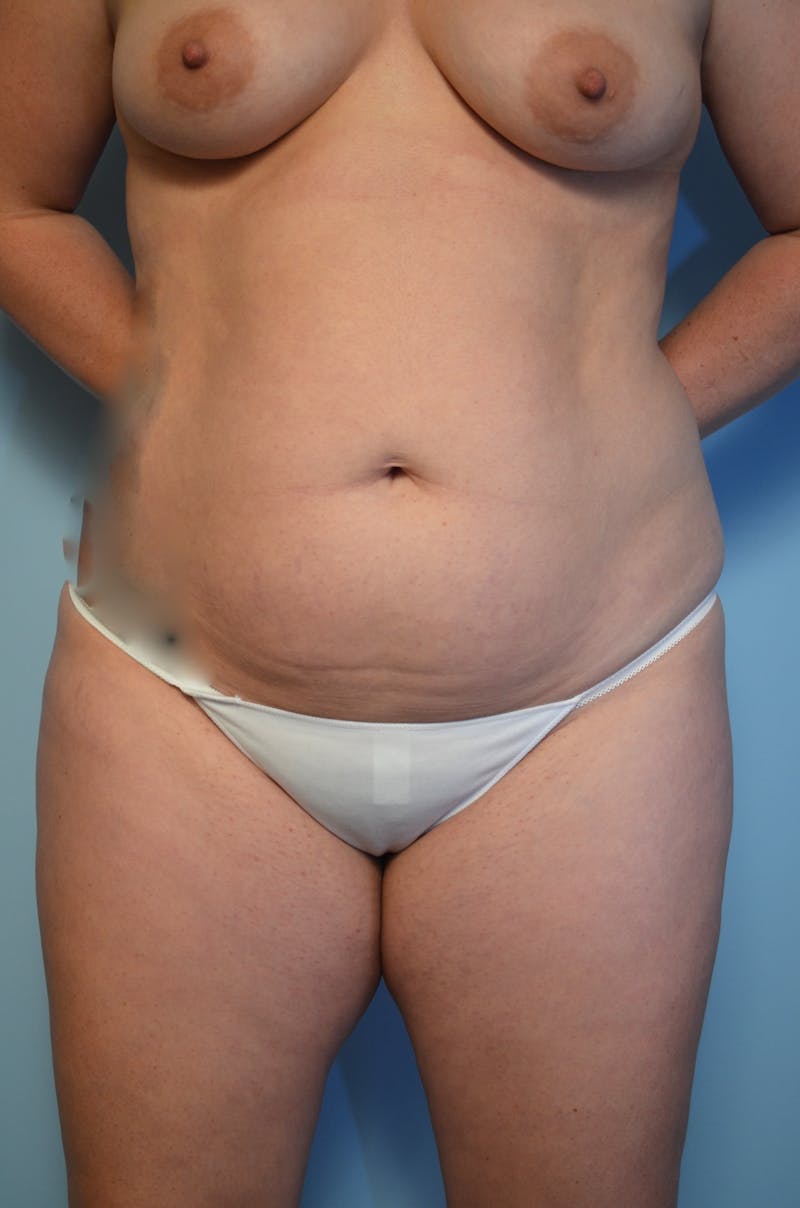 Liposuction Before & After Gallery - Patient 223613 - Image 3