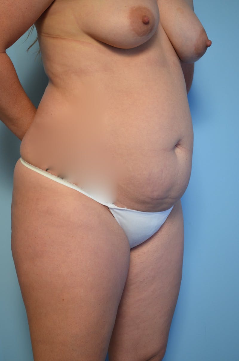 Liposuction Before & After Gallery - Patient 223613 - Image 5