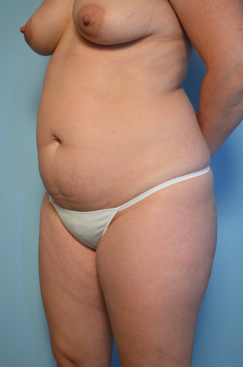 Liposuction Before & After Gallery - Patient 223613 - Image 9