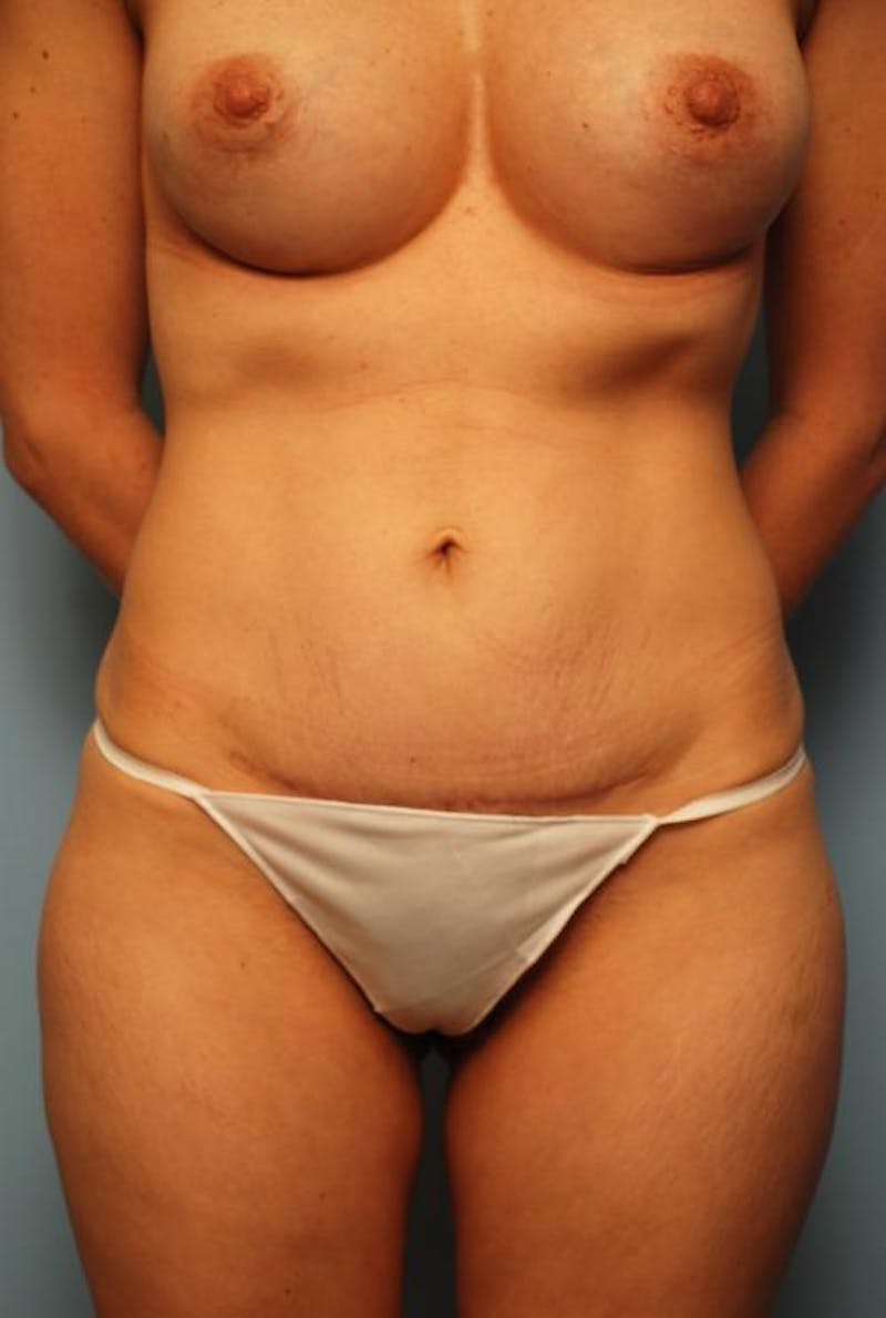 Mini Tummy Tuck Before & After Gallery - Patient 147461 - Image 2