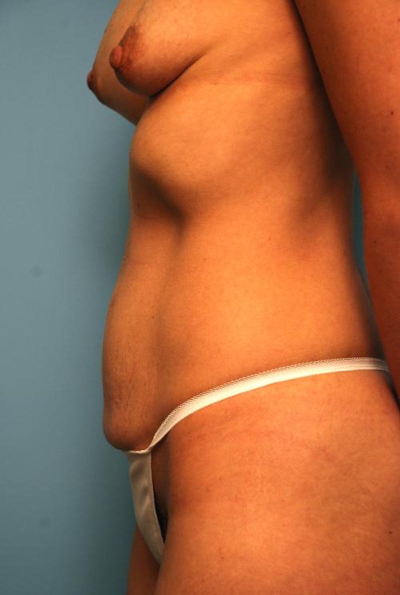 Mini Tummy Tuck Before & After Gallery - Patient 147461 - Image 9
