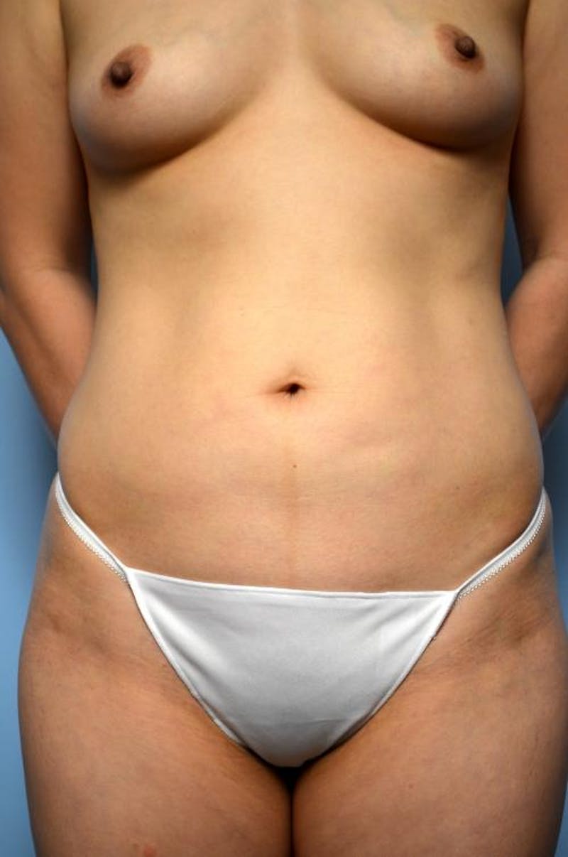 Mini Tummy Tuck Before & After Gallery - Patient 149675 - Image 1
