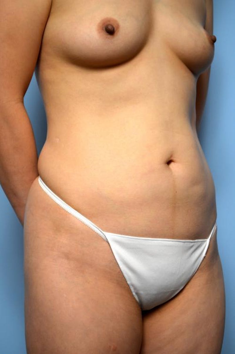 Mini Tummy Tuck Before & After Gallery - Patient 149675 - Image 3