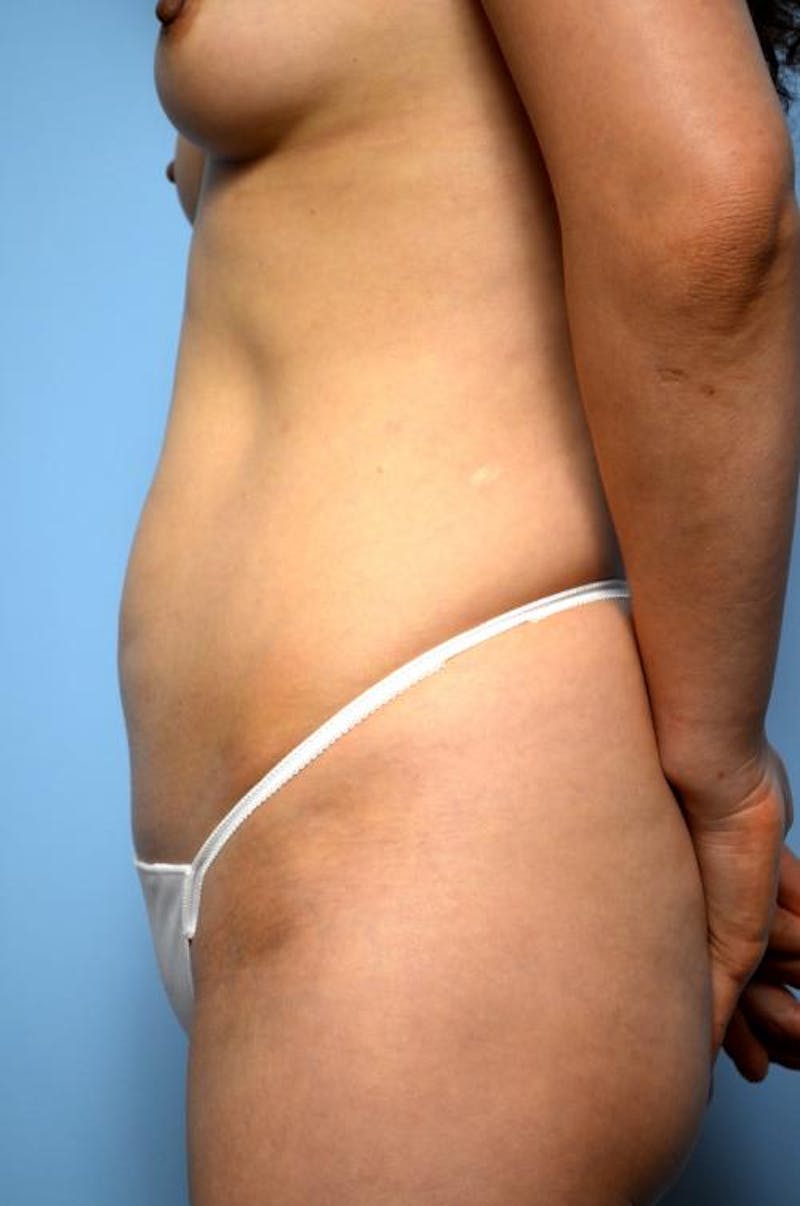 Mini Tummy Tuck Before & After Gallery - Patient 149675 - Image 9