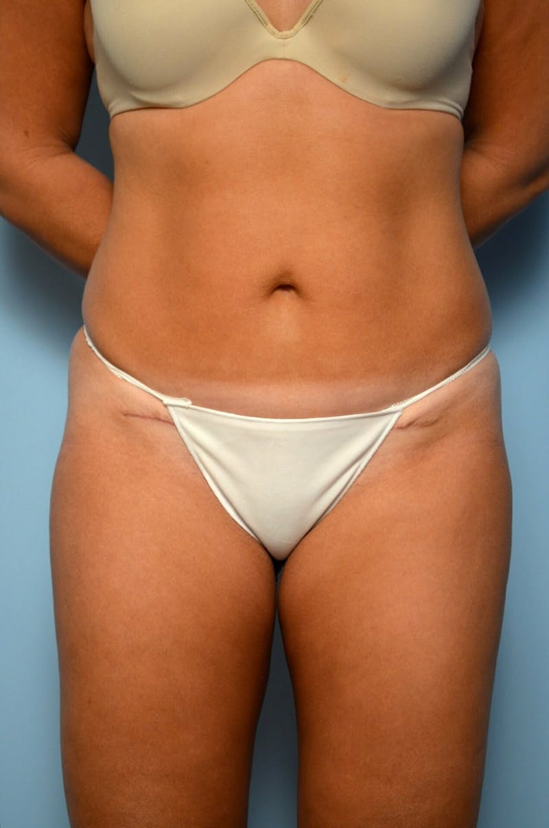 Mini Tummy Tuck Before & After Gallery - Patient 528358 - Image 2