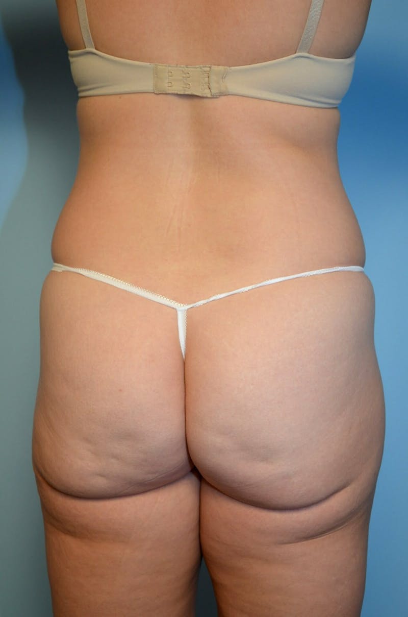 Mini Tummy Tuck Before & After Gallery - Patient 528358 - Image 11