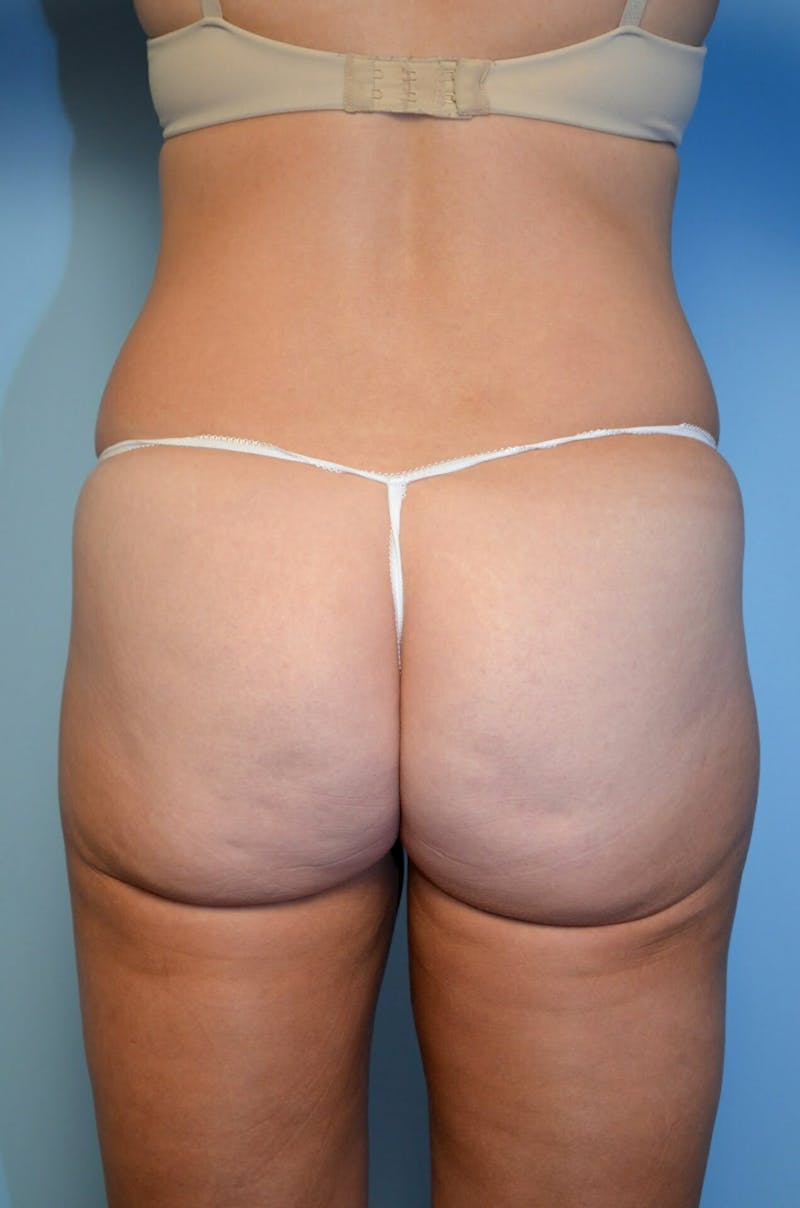 Mini Tummy Tuck Before & After Gallery - Patient 528358 - Image 12