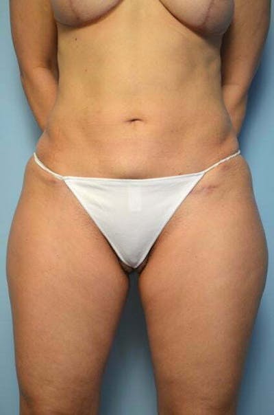 Mini Tummy Tuck Before & After Gallery - Patient 417054 - Image 2
