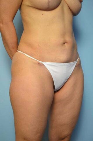 Mini Tummy Tuck Before & After Gallery - Patient 204411 - Image 4
