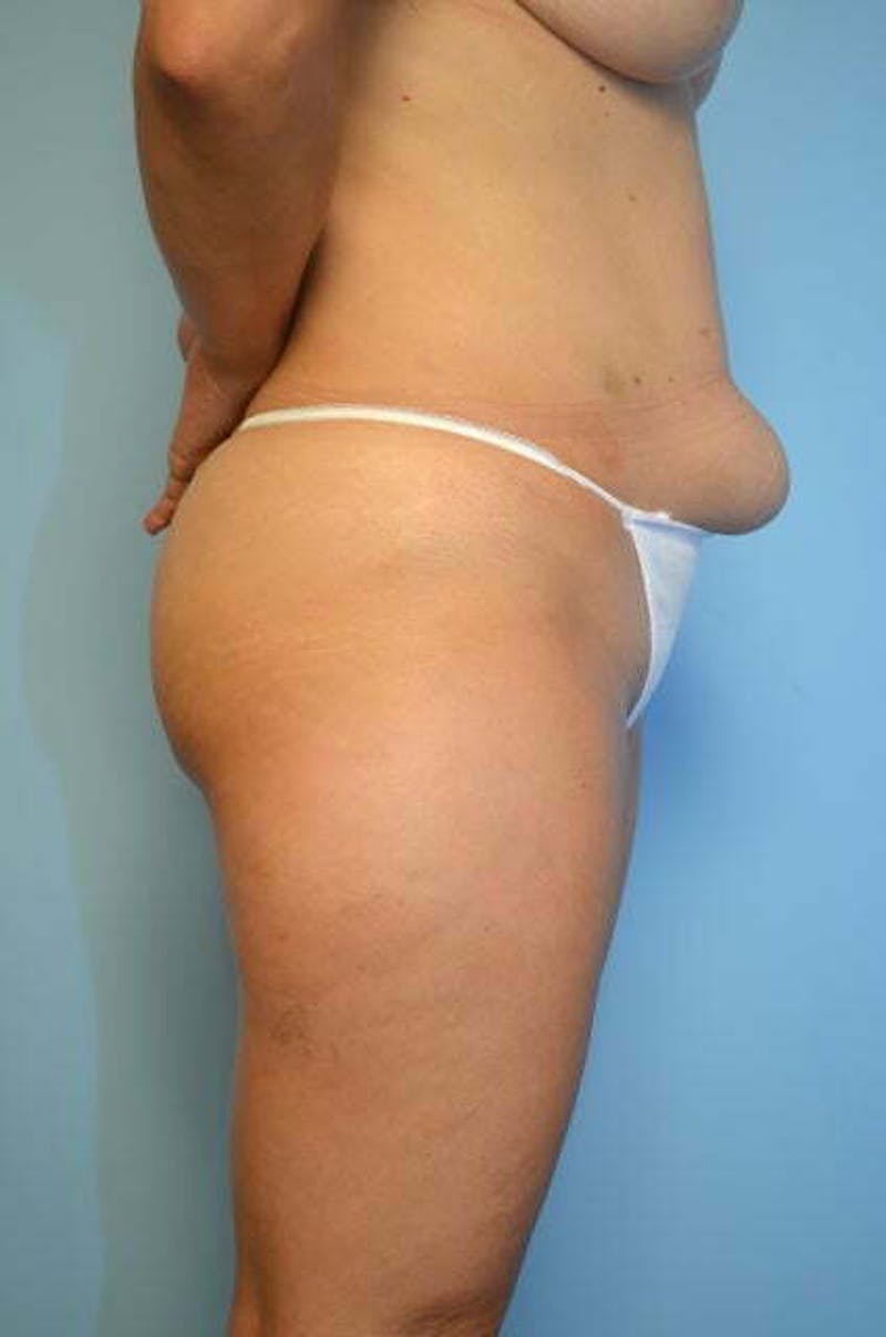 Mini Tummy Tuck Before & After Gallery - Patient 204411 - Image 5