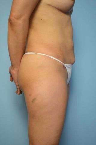 Mini Tummy Tuck Before & After Gallery - Patient 204411 - Image 6