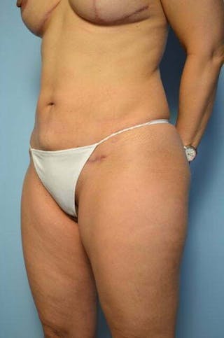 Mini Tummy Tuck Before & After Gallery - Patient 204411 - Image 8