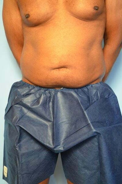 Mini Tummy Tuck Before & After Gallery - Patient 480540 - Image 1