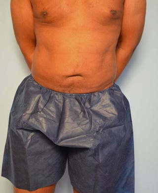 Liposuction Before & After Gallery - Patient 152179 - Image 2