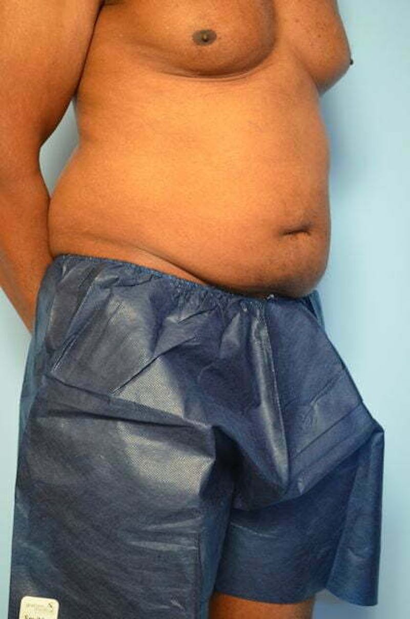 Liposuction Before & After Gallery - Patient 152179 - Image 3