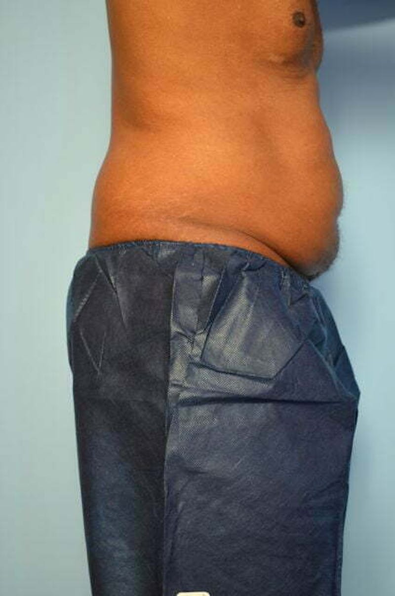 Liposuction Before & After Gallery - Patient 152179 - Image 5
