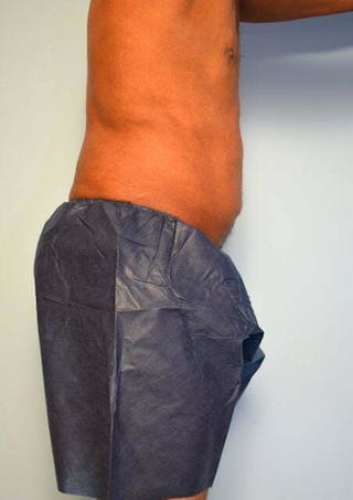 Liposuction Before & After Gallery - Patient 152179 - Image 6