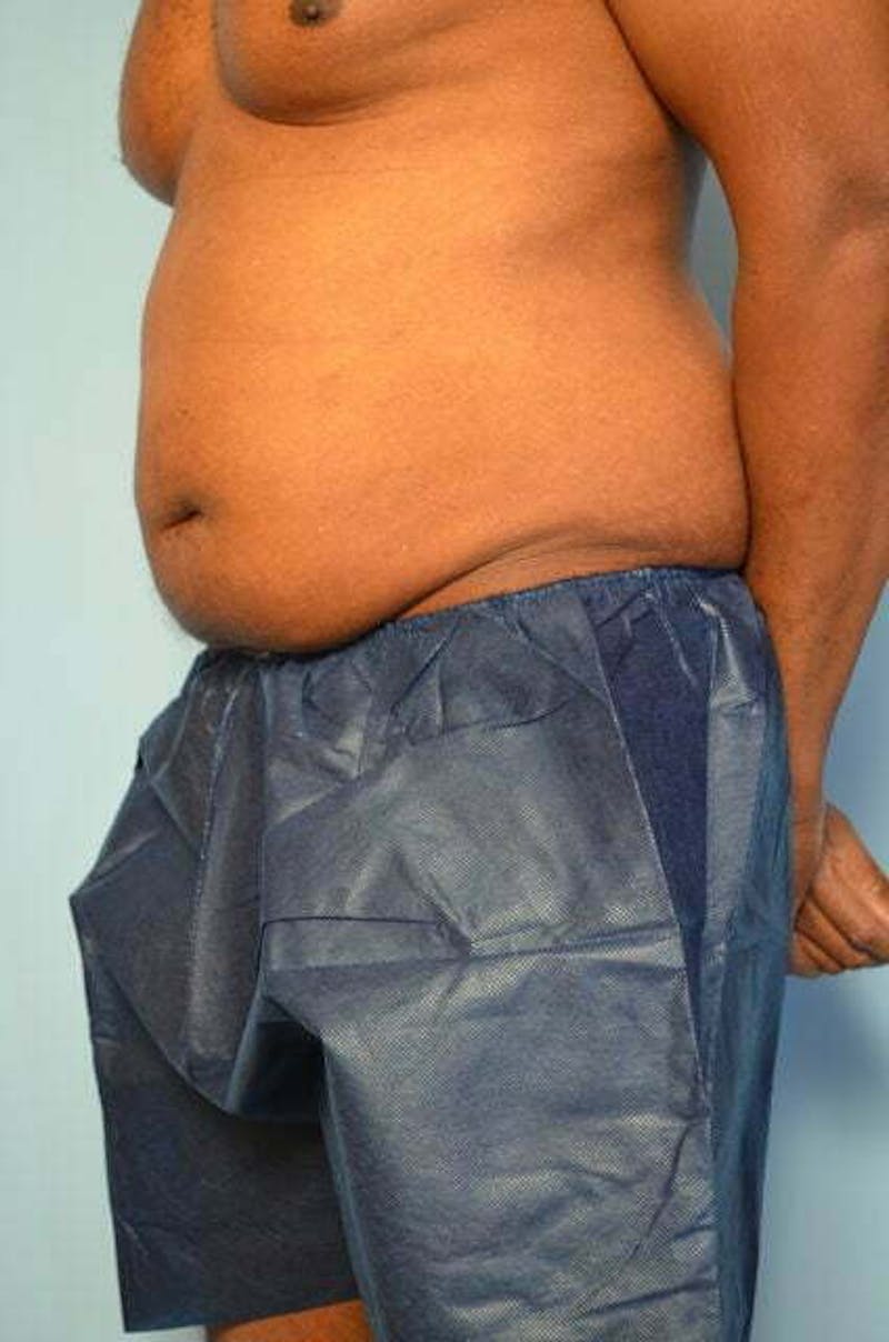 Liposuction Before & After Gallery - Patient 152179 - Image 7