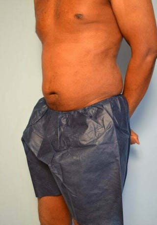 Liposuction Before & After Gallery - Patient 152179 - Image 8