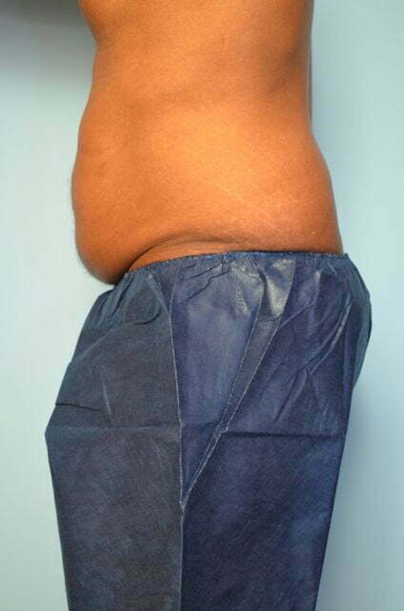 Liposuction Before & After Gallery - Patient 152179 - Image 9