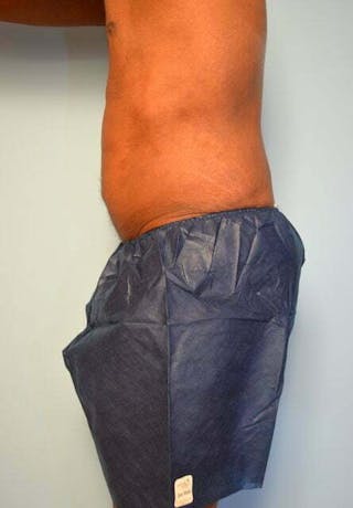 Liposuction Before & After Gallery - Patient 152179 - Image 10