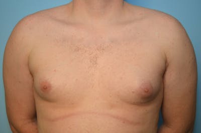 Male Procedures by Dr. Hess Before & After Gallery - Patient 250318 - Image 1