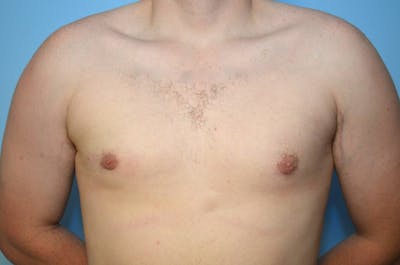 Male Procedures by Dr. Hess Before & After Gallery - Patient 250318 - Image 2