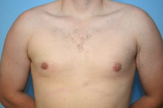 Male Breast Reduction Before & After Gallery - Patient 250318 - Image 2