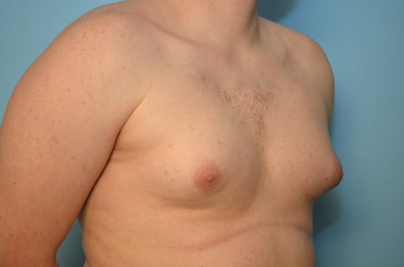 Male Procedures by Dr. Hess Before & After Gallery - Patient 250318 - Image 3