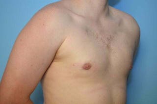 Male Breast Reduction Before & After Gallery - Patient 250318 - Image 4