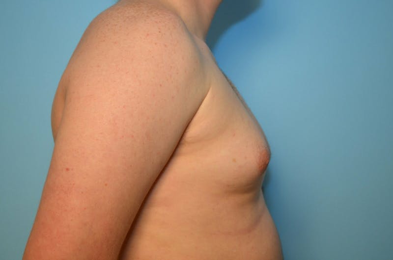 Male Procedures by Dr. Hess Before & After Gallery - Patient 250318 - Image 5