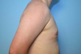 Male Breast Reduction Before & After Gallery - Patient 250318 - Image 6