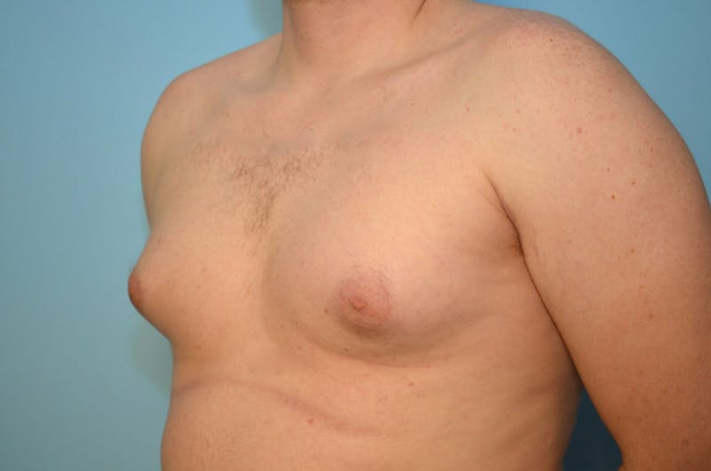 Male Procedures by Dr. Hess Before & After Gallery - Patient 250318 - Image 7