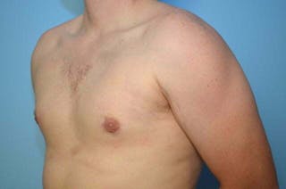 Male Breast Reduction Before & After Gallery - Patient 250318 - Image 8