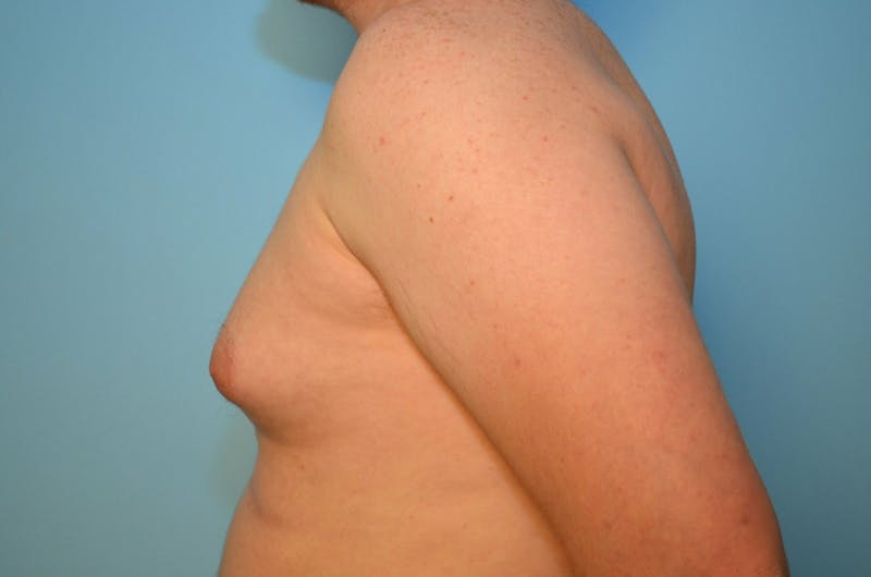 Male Procedures by Dr. Hess Before & After Gallery - Patient 250318 - Image 9