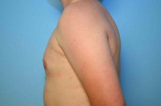 Male Breast Reduction Before & After Gallery - Patient 250318 - Image 10