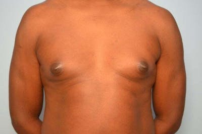 Male Procedures by Dr. Hess Before & After Gallery - Patient 385736 - Image 1