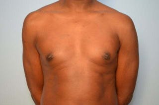 Male Breast Reduction Before & After Gallery - Patient 385736 - Image 2