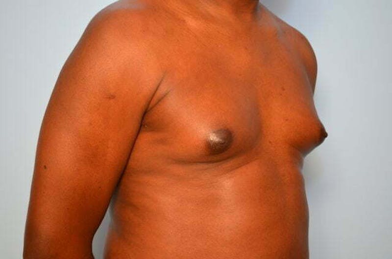 Male Procedures by Dr. Hess Before & After Gallery - Patient 385736 - Image 3